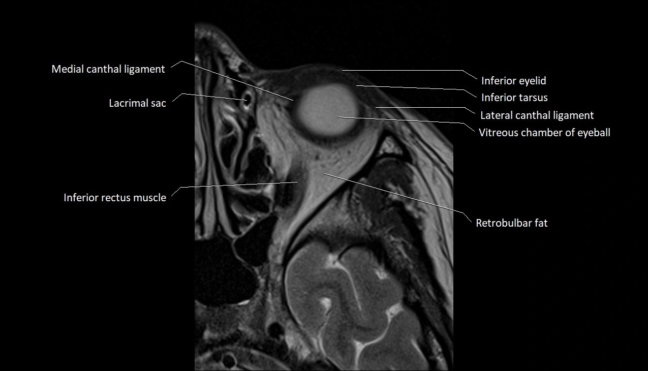 MRI Orbit axial cross sectional anatomy image 5.webp